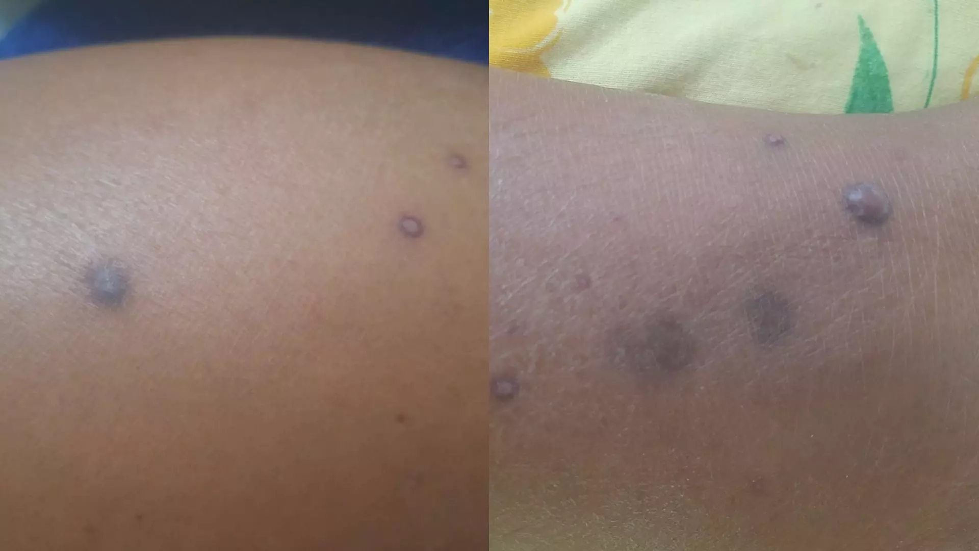 suspeita-mpox