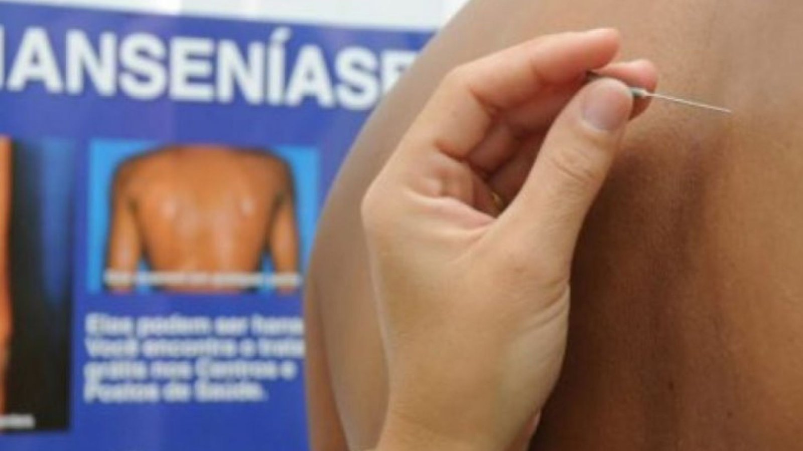 HANSENIASE
